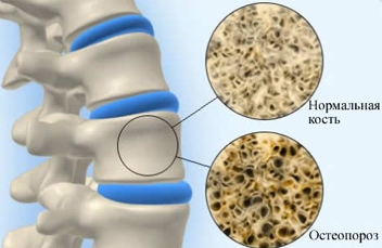 Профилактика и лечение остеопороза